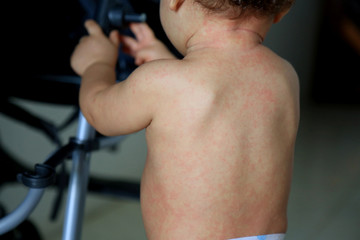 Child with measles symptoms - obrazy, fototapety, plakaty