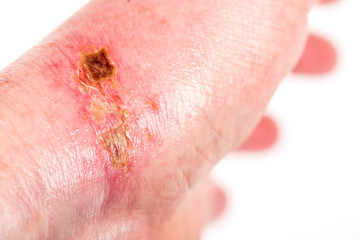 chemical burn on the wrist skin with hydroxide sodium acid, by striping paint from wood furniture....
