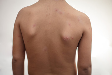 Impaired immunity brings about various diseases.