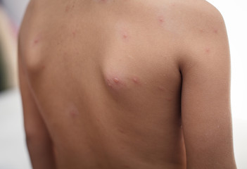 Fototapeta premium Back with blisters.