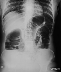 Film of abdomen series,X ray of abdomen.