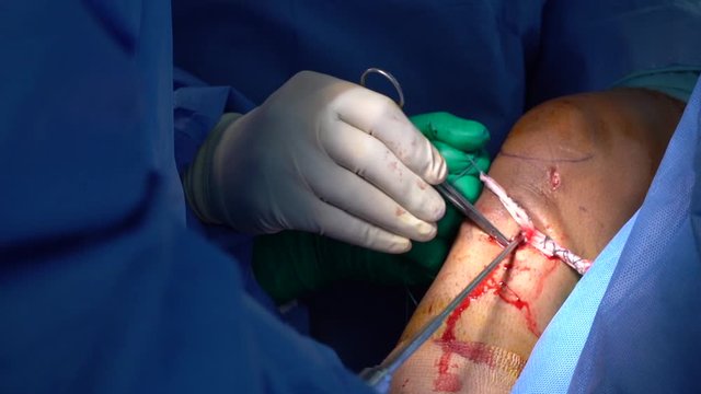 Doctor screwing screw in knee (ACL Reconstruction)