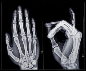 X-ray fluoroscopy of human fingers