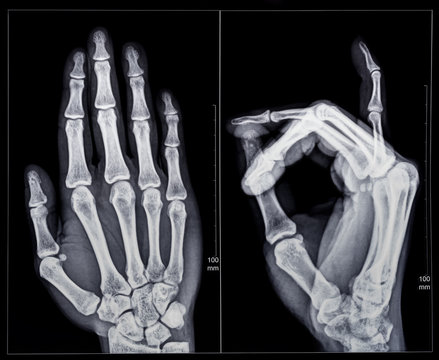 X-ray fluoroscopy of human fingers