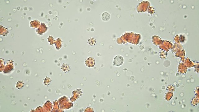 blood under a microscope, on the video leukocytes, red blood cells (echinocytes) and a lot of platelets: simple (aggregating) and overactive (procoagulant). This happens when the vessels are damaged a