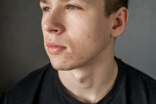 Young man struggling with acne on his face caring for his skin pushes acne