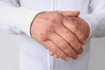 Close up of male hands with dry skin damage. Dermatology concept human hands with skin with cracks...