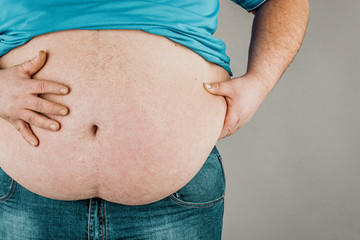 Overweight of a person's body with hands touching the abdomen. The concept of obesity