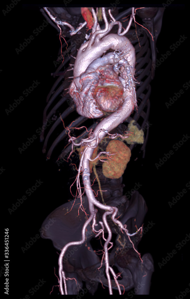 Aufkleber cta abdominal aorta 3d rendering image on transparent skeletal .