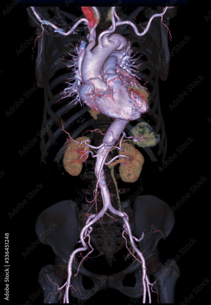 Aufkleber cta abdominal aorta 3d rendering image on transparent skeletal .