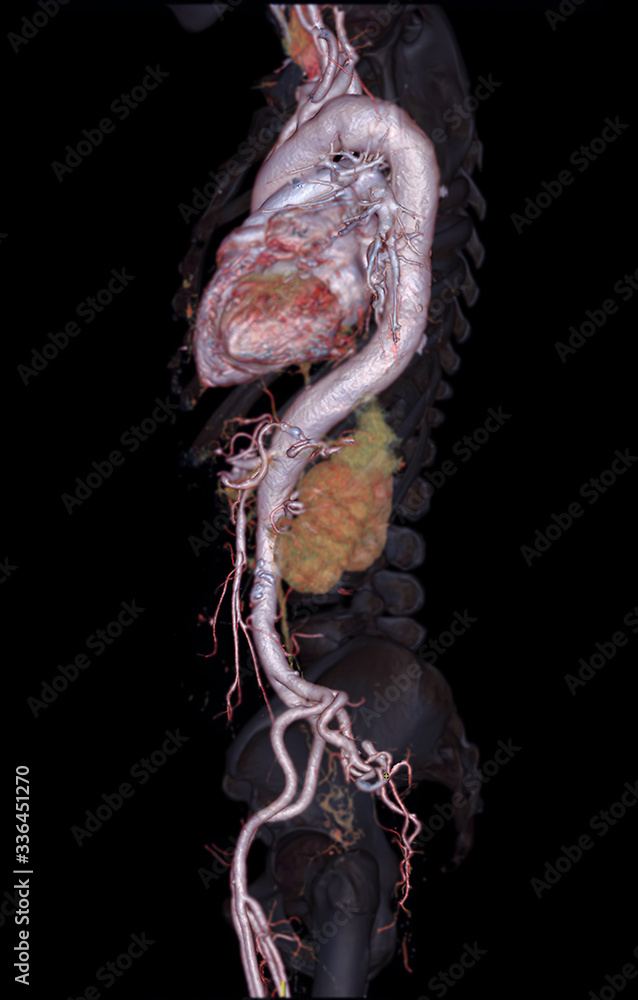 Poster cta abdominal aorta 3d rendering image on transparent skeletal .
