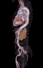 CTA abdominal aorta 3D rendering image  on transparent skeletal .
