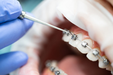 Patient's open mouth at the dentist's appointment. The procedure for servicing braces. Orthodontics. Macro photo.