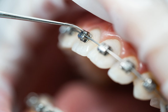 Patient's open mouth at the dentist's appointment. Braces maintenance procedure, cleaning and tightening. Orthodontics. Macro photo.