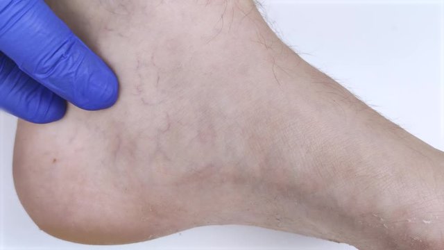 A man in consultation with a vascular surgeon. A doctor examines a leg with swollen veins. Varicose veins on the leg