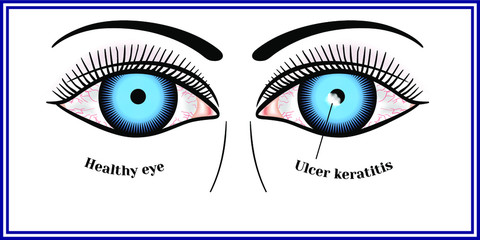 Ulcerative keratitis. Destructive, ulcerative inflammatory process in the cornea.