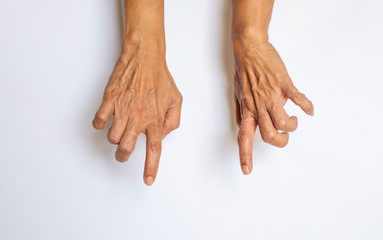 Trigger Finger a defect in a tendon causing a finger to jerk or snap straight when the hand is...