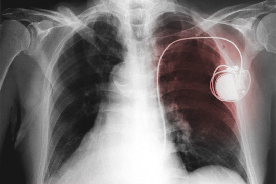 xray film image of chest with the pacemaker