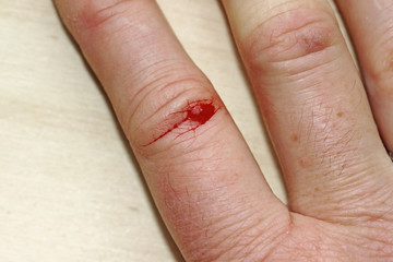 Eine blutende Verletzung am Finger von einer Frau. Eine blutende Wunde an der Hand