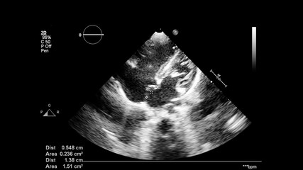 Image of the heart in gray-scale mode during transesophageal ultrasound.