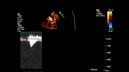 Image of the heart during transesophageal ultrasound with Doppler mode.