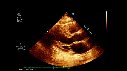 Image of the heart in gray-scale mode during transesophageal ultrasound.