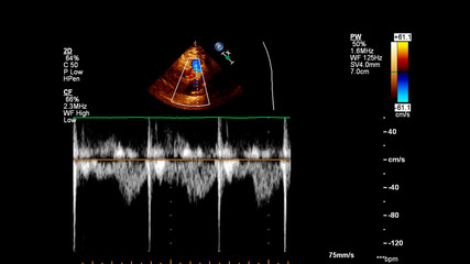 Image of the heart during transesophageal ultrasound with Doppler mode.