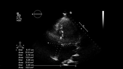 Image of the heart in gray-scale mode during transesophageal ultrasound.