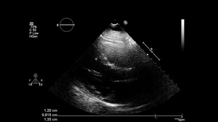 Image of the heart in gray-scale mode during transesophageal ultrasound.