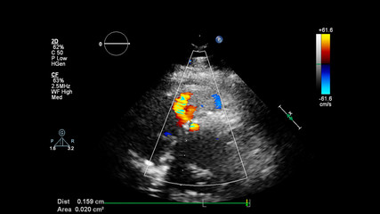 Image of the heart during transesophageal ultrasound with Doppler mode.