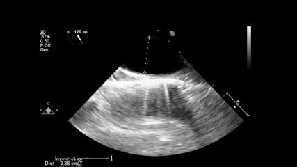 Image of the heart in gray-scale mode during transesophageal ultrasound.