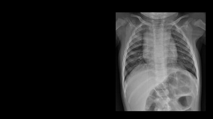 Film chest  X-ray radiograph show  infiltration at upper lobe. This cause form pneumonia, pulmonary tuberculosis (TB), viral infection, restrictive lung disease, cancer (CA). Medical imaging concept 