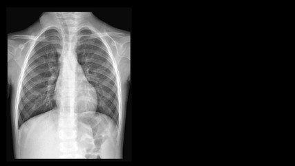 Film X ray chest radiograph (CXR) show perihilar infiltration and pleural thickening. This cause...