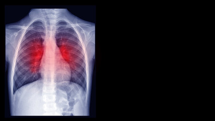 Film X-ray chest radiograph (CXR) show perihilar infiltration and pleural thickening. This cause form viral pneumonia and bronchitis infection disease. Medical imaging investigation concept
