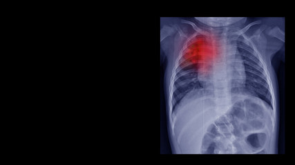 Film chest  X ray radiograph show  infiltration at upper lobe. This cause form pneumonia, pulmonary tuberculosis (TB), viral infection, restrictive lung disease, cancer (CA). Medical imaging concept 