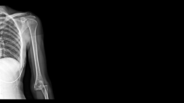 Film X ray elbow radiograph show elbow dislocation. Joint dislocation injury from trauma accident. The patient has elbow pain and limit joint motion. Medical imaging and diagnosis technology concept.