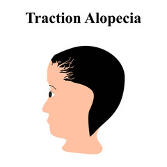 Alopecia hair. Baldness of hair on the head. Traction alopecia. Infographics. Vector illustration on isolated background.