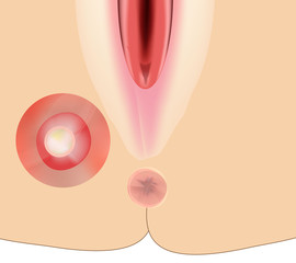 Paraproctitis. Abscess in the perineum. Inflammation paraproctitis. Infographics. Vector illustration on isolated background.