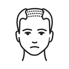 Man with a bald head black line icon. Baldness stage. Alopecia. Pictogram for web page, mobile app, promo. UI UX GUI design element. Editable stroke.