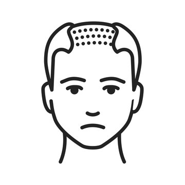 recommend clip art: Man with a bald head black line icon. Baldness stage. Alopecia. Pictogram for web page, mobile app, promo. UI UX GUI design element. Editable stroke.