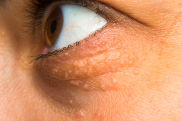 close-up photo of a women face with fat points near eye