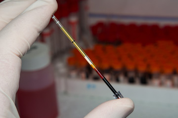 close-up photo of a blood sample in the hand of a laboratory worker