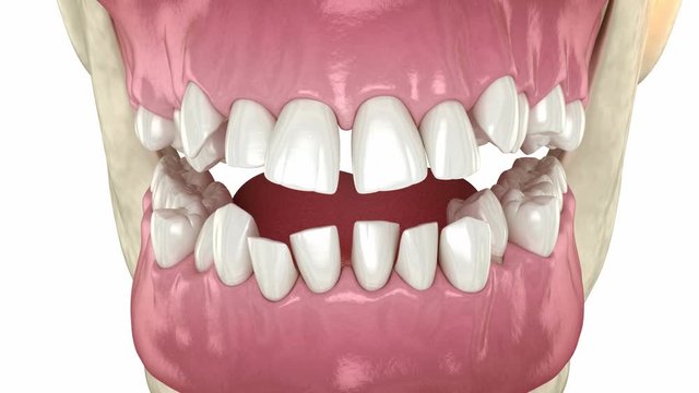 Abnormal teeth position, orthodontic concept. Medically accurate tooth 3D animation