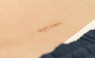 Fresh appendix surgical wound after suture removal in appendectomy surgery, patient recover in hospital