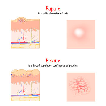 Skin lesion. Papule and Plaque. side and top view. Cross section of the human skin.
