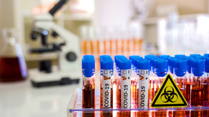 The test tubes with blood samples of Covid-19 or coronavirus
