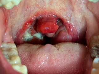 Obraz premium chronic tonsillitis. damage to the mucous membranes in the oral cavity.