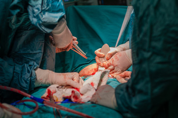 Hysterectomy surgery,  Male surgeon doctor at operation