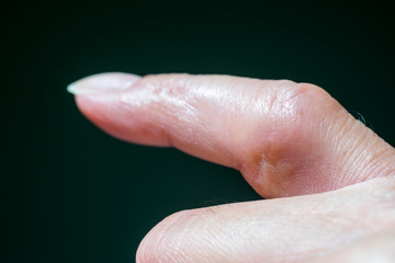 The right little finger, recovering from a dislocation rupture at the Metacarpophalangeal Joint. This photo taken 6 weeks after injury, shows skin healing after removing stitches and minor swelling. 