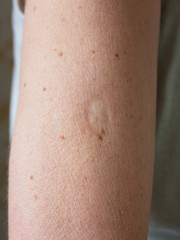 BCG vaccination mark on a woman's arm